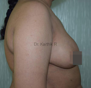 Breast Reduction and Breast Lift