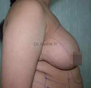 Breast Reduction and Breast Lift