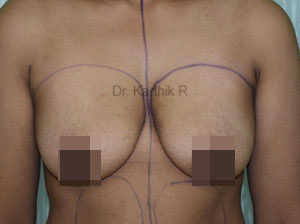 Breast Fat Fill (Breast Augmentation)