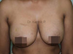 Breast Fat Fill (Breast Augmentation)