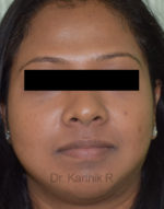 Chemical Peels & Microdermabrasion