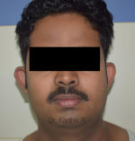 Otoplasty (Ear Correction)