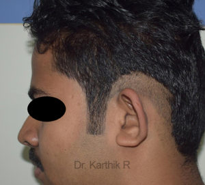 Otoplasty (Ear Correction)