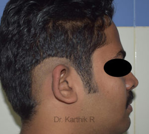 Otoplasty (Ear Correction)
