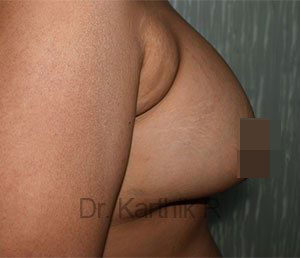 Breast Fat Fill (Breast Augmentation)