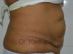 Tummy Tuck