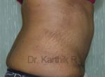 Tummy Tuck