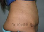Tummy Tuck