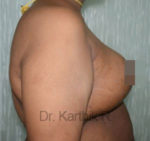 Breast Reduction and Breast Lift