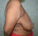 Breast Reduction and Breast Lift