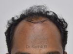 Hair Transplant
