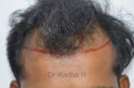 Hair Transplant