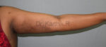 Liposuction Arms and Arm Tuck