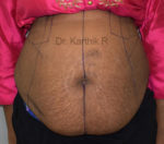 Tummy Tuck
