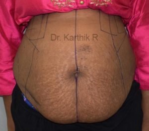 Tummy Tuck
