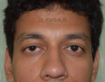 Blepharoplasty