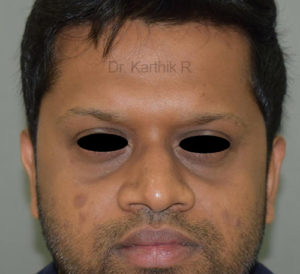 Fat Graft / Fat Fill/ Fat Transfer