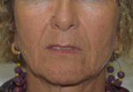 Dermal Fillers