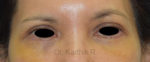 Blepharoplasty