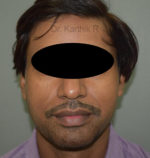 Fat Graft / Fat Fill/ Fat Transfer