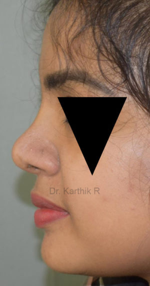 Rhinoplasty (Nose Corrections)