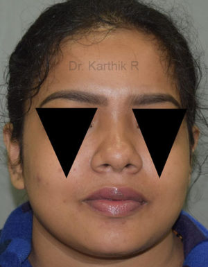 Rhinoplasty (Nose Corrections)