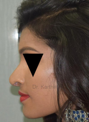 Rhinoplasty (Nose Corrections)