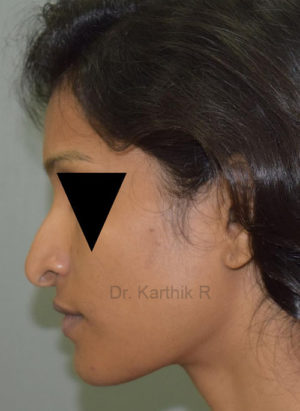 Rhinoplasty (Nose Corrections)