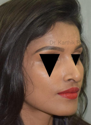 Rhinoplasty (Nose Corrections)