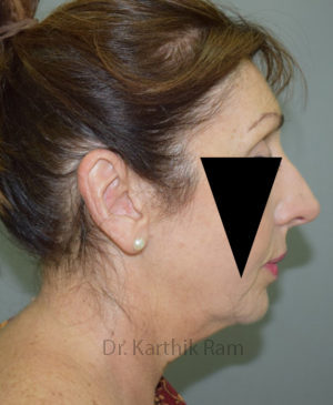 Rhinoplasty (Nose Corrections)