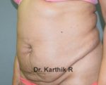 Mini Tummy Tuck (Panniculectomy)