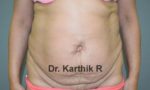 Mini Tummy Tuck (Panniculectomy)