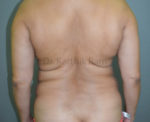 Liposuction Tummy and Back