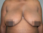 Breast Reduction and Breast Lift