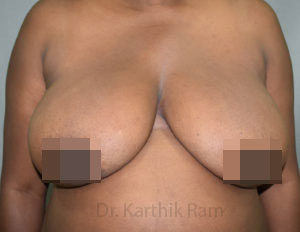 Breast Reduction and Breast Lift