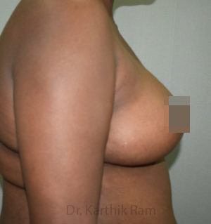 Breast Reduction and Breast Lift