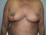 Breast Reduction and Breast Lift