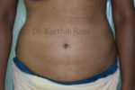 Liposuction Tummy and Back
