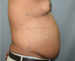 Liposuction Tummy and Back