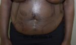 Tummy Tuck
