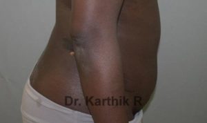 Tummy Tuck