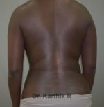 Liposuction Tummy and Back
