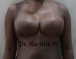 Breast Reduction and Breast Lift