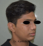 Rhinoplasty (Nose Corrections)