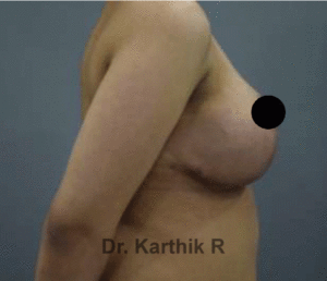 Breast Reduction and Breast Lift