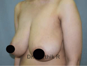 Breast Reduction and Breast Lift
