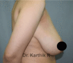 Breast Reduction and Breast Lift