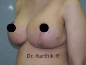 Breast Reduction and Breast Lift