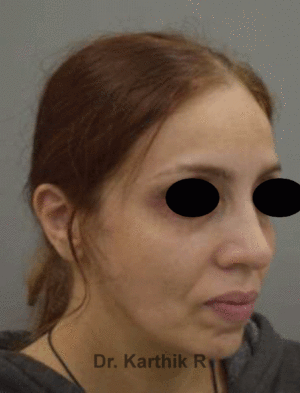 Fat Graft / Fat Fill/ Fat Transfer