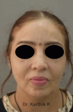 Fat Graft / Fat Fill/ Fat Transfer